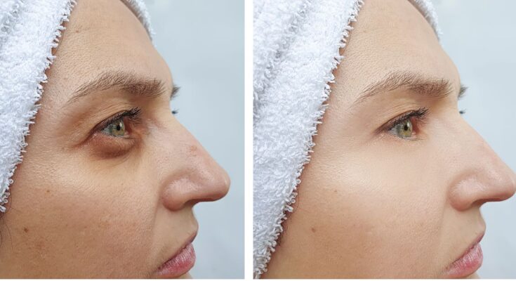 Sötét karikák a szem körül?