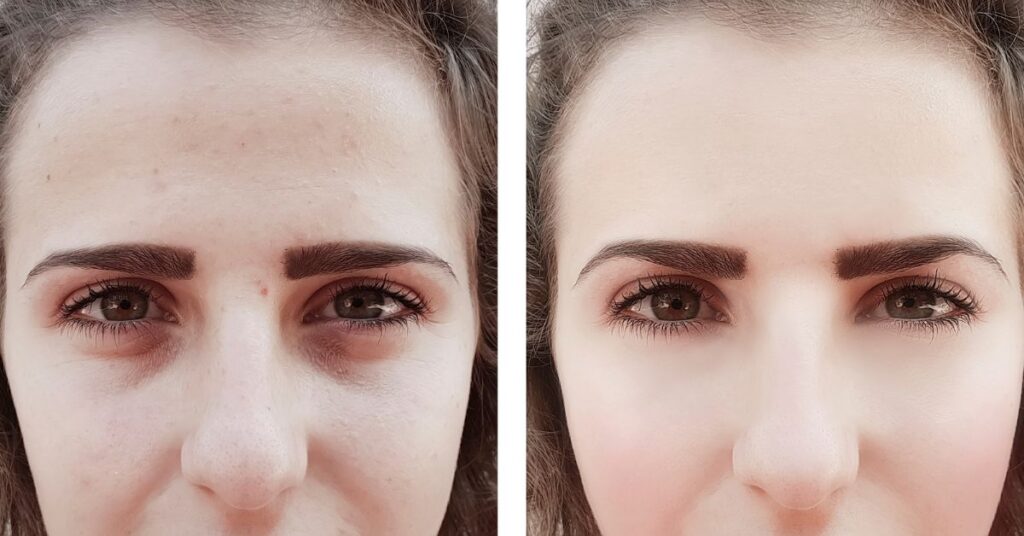 Háromszor vékonyabb, mint az arc egyéb területein.