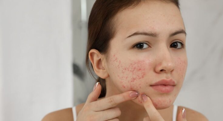 Az akné hatékony kezelése