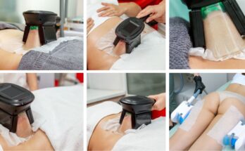 Zsírfagyasztás Érden. Tuti módszer a zsírsejtek csökkentésére