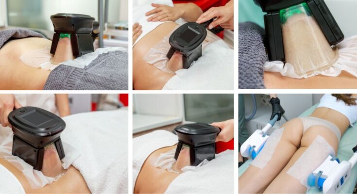 Zsírfagyasztás Érden. Tuti módszer a zsírsejtek csökkentésére