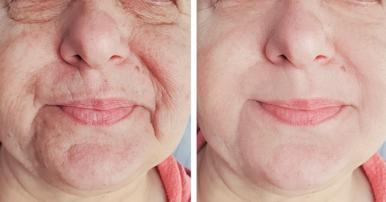 A bőrünk az idő múlásával természetesen veszít a rugalmasságából és a fiatalos megjelenéséből