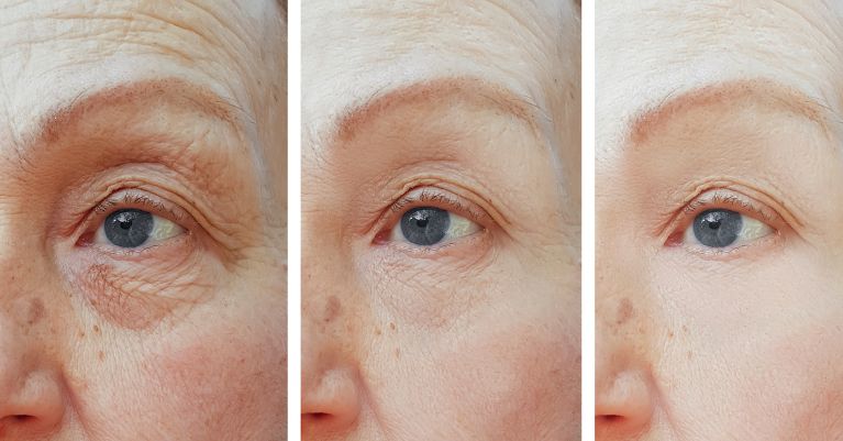 Hogyan működik a DUET RF frakcionált rádiófrekvenciás kezelés Debrecenben?